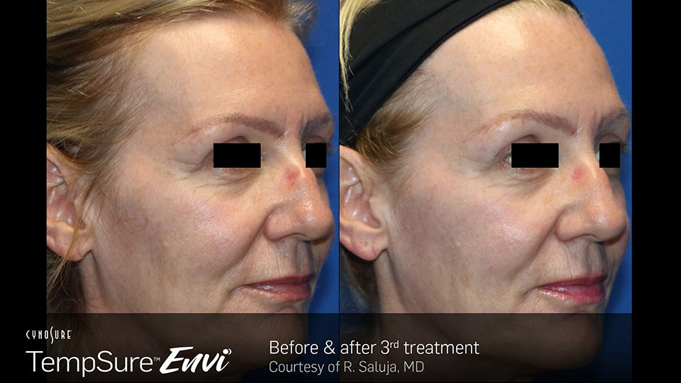 TempSure Envi Before and After