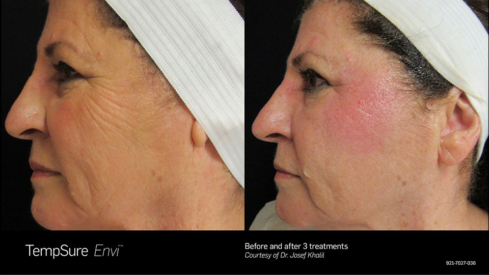 TempSure Envi Before and After