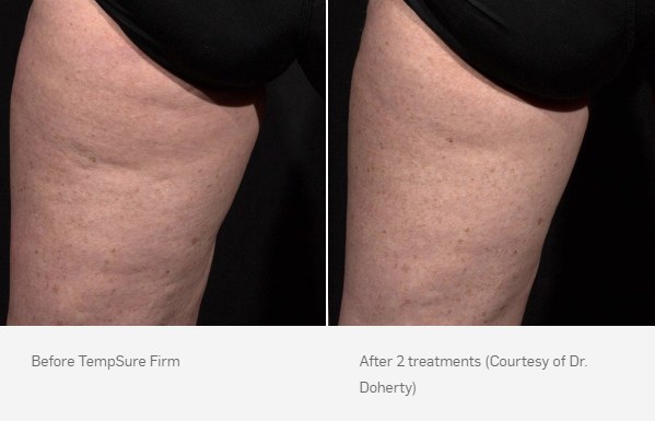 TempSure Firm Before and After
