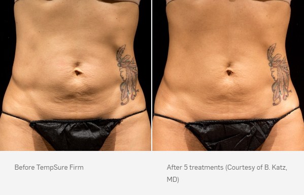TempSure Firm Before and After