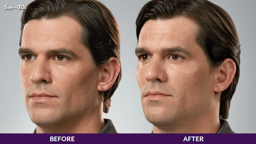 JUVEDERM Before & After