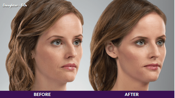 JUVEDERM Before & After